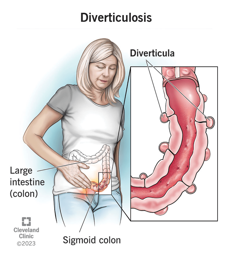 Diverticulitis Icd 10 Symptoms And Diagnosis